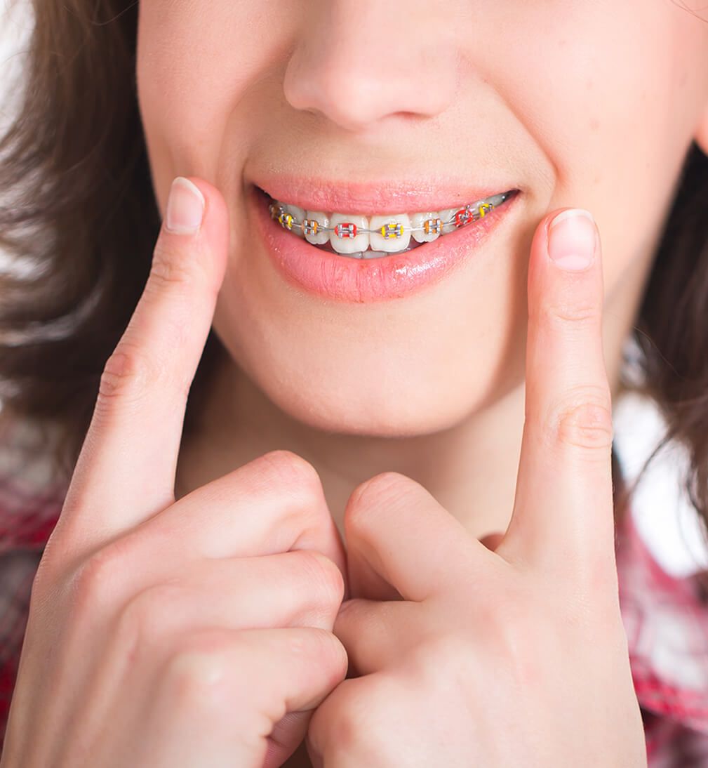 Girl wearing colourful metal braces