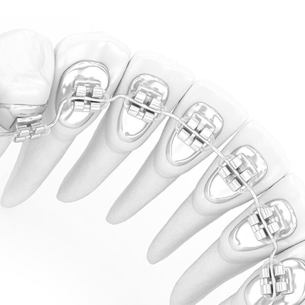 Lingual Braces Banner