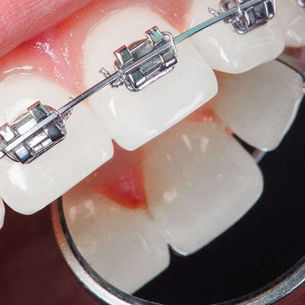 Teeth with Metal Braces