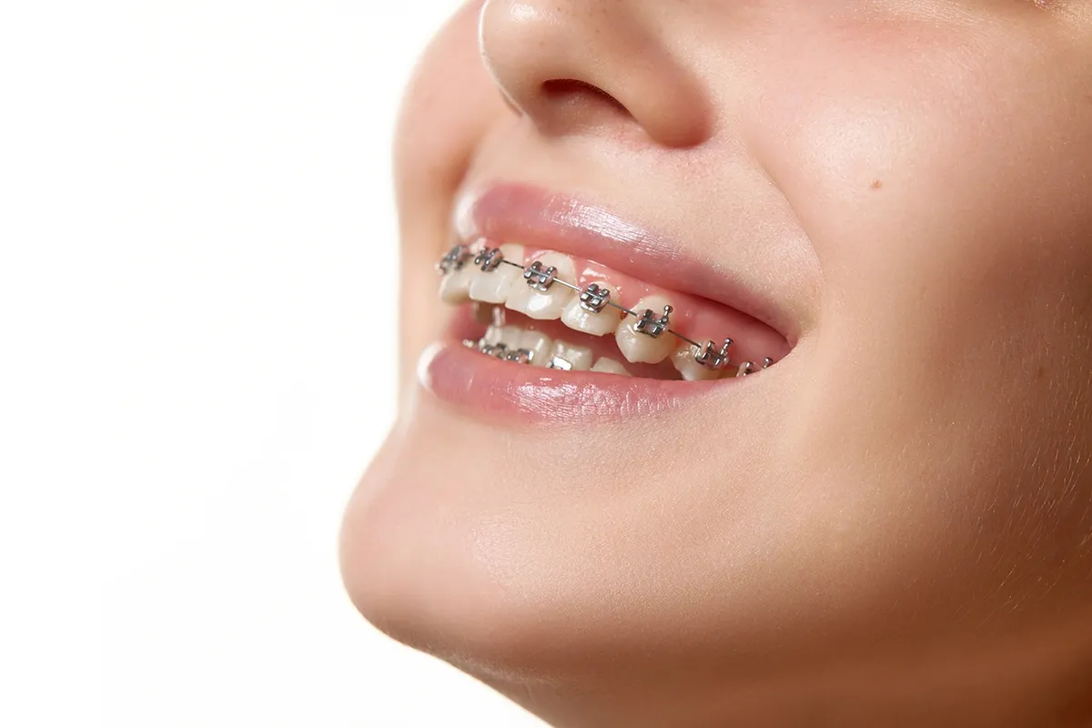 Close-up portrait of a female model smiling with dental braces, showing aligned teeth and ongoing orthodontic treatment.