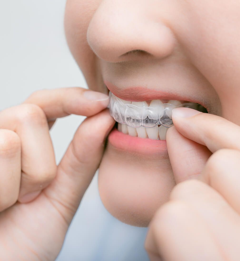Girl wearing clear aligners