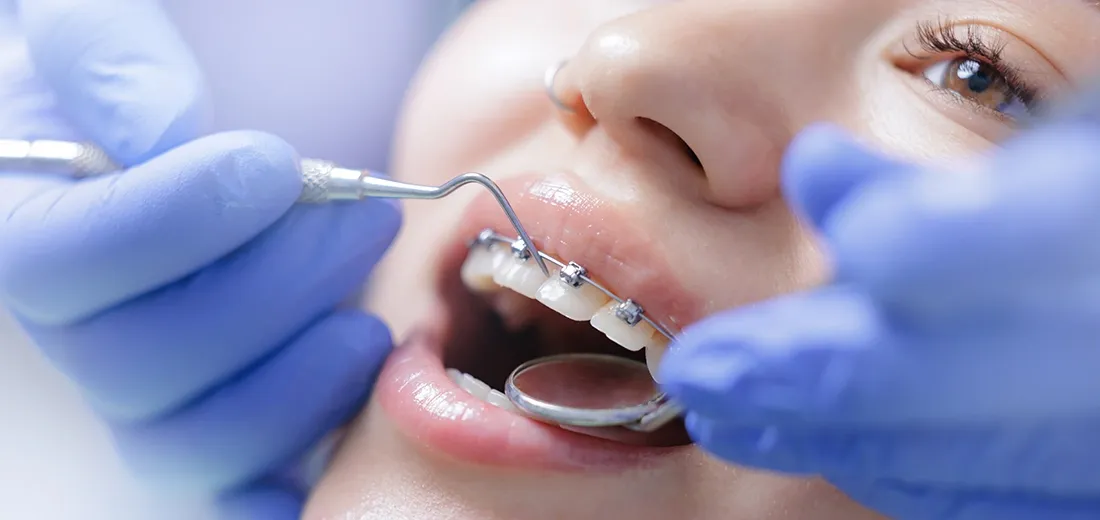 Why Metal Braces Are Still Widely Used for Complex Alignment