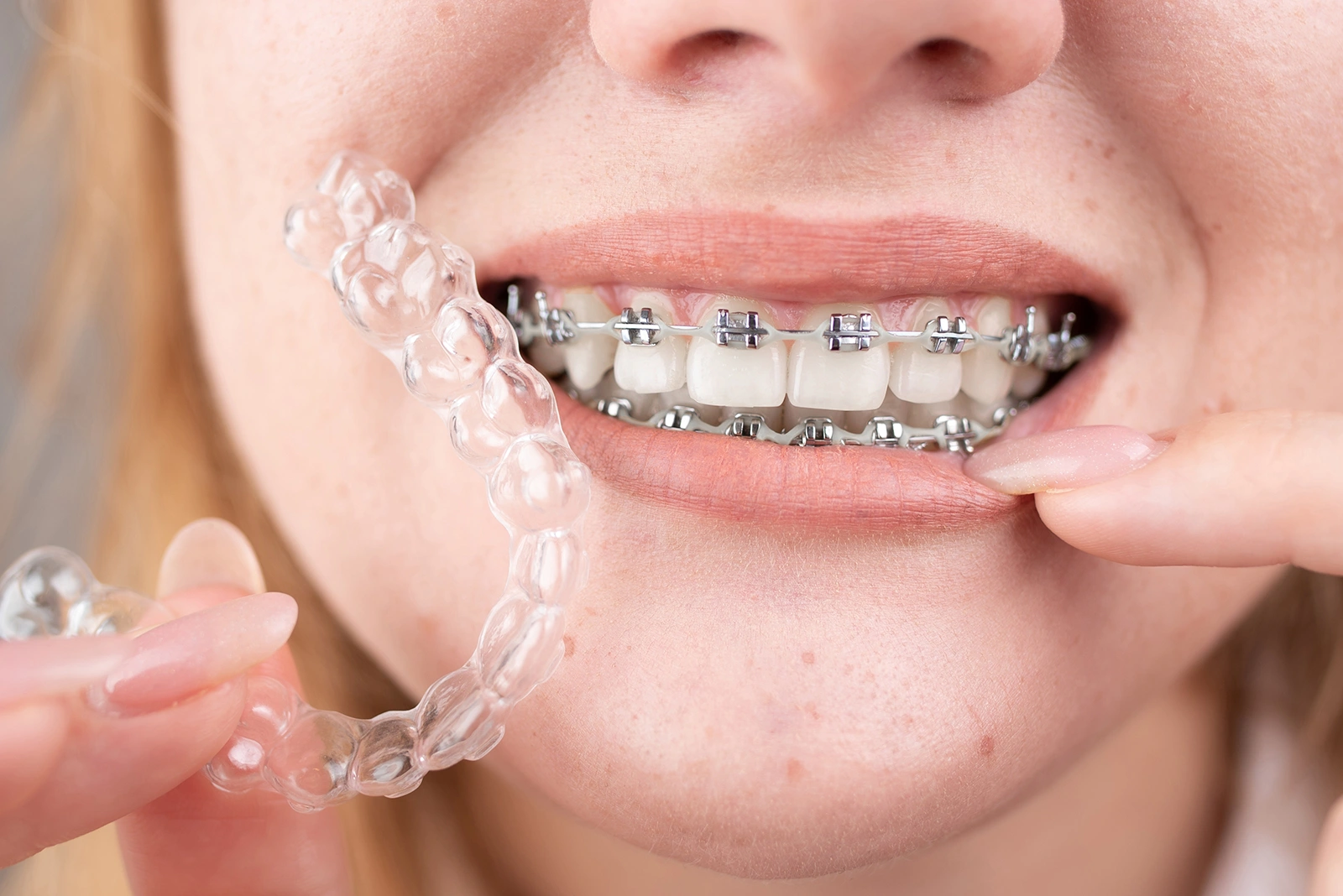 How to Choose the Right Braces for You