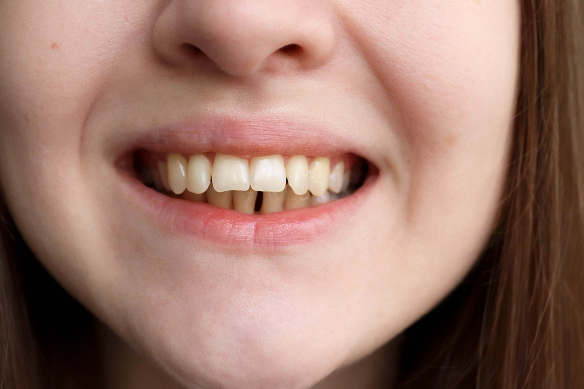 Close-up of a woman’s smile showing malocclusion with an overbite, indicating the need for orthodontic treatment.