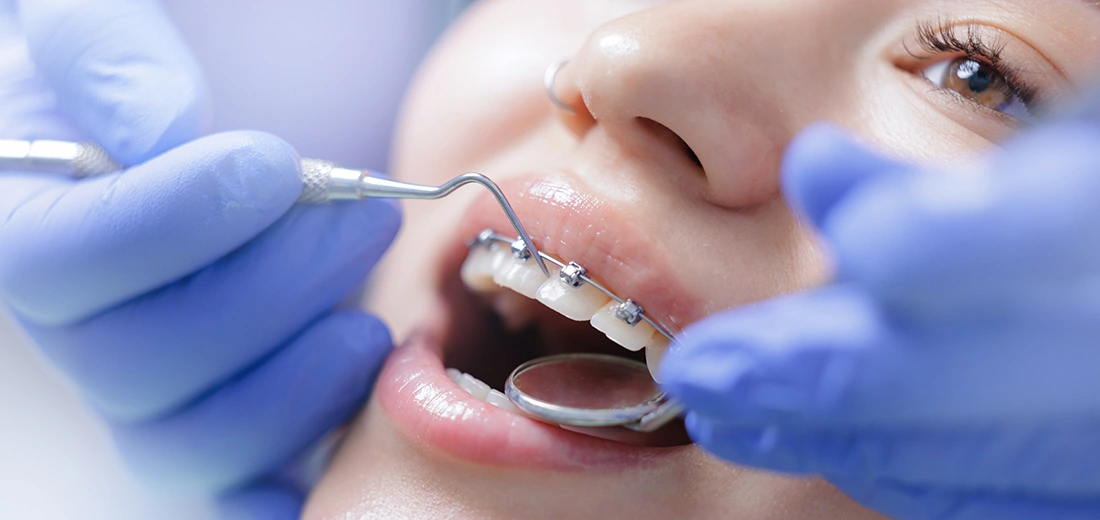 Why Metal Braces Are Still Widely Used for Complex Alignment