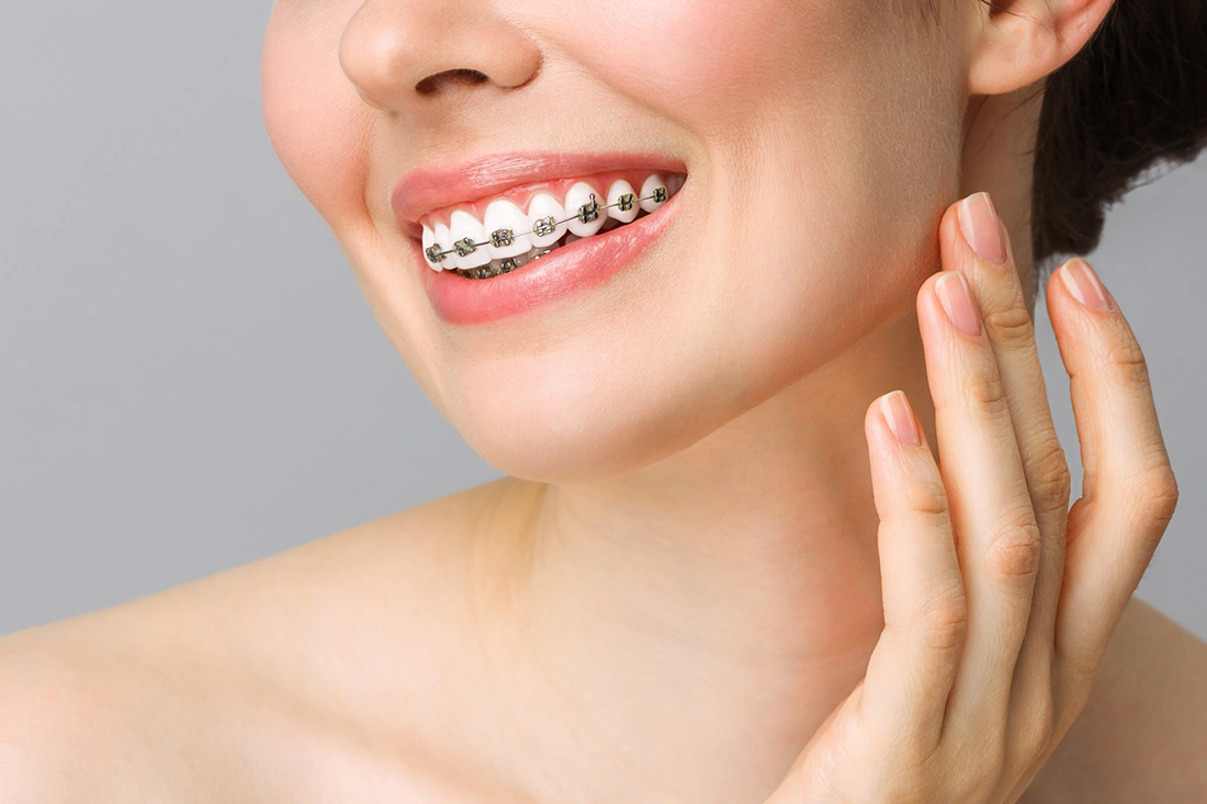 Close‑up of a smiling woman showing her healthy teeth with metal orthodontic braces.