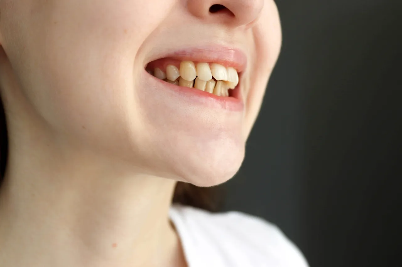 What Can Happen If a Misaligned Bite Goes Undiagnosed?